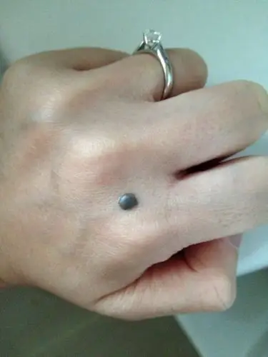 痣医院_治疗痣哪家医院好_治疗痣最好的医院/排行_有来医生