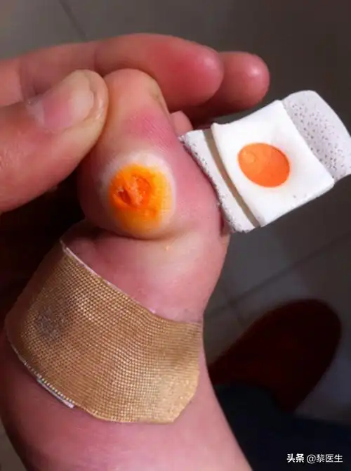 虽然说用刀削去除鸡眼的方法是不可取,对于治疗鸡眼还是有办法的,主要