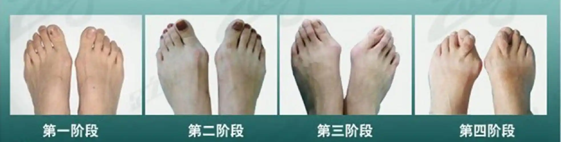 拇外翻不同阶段对比图片