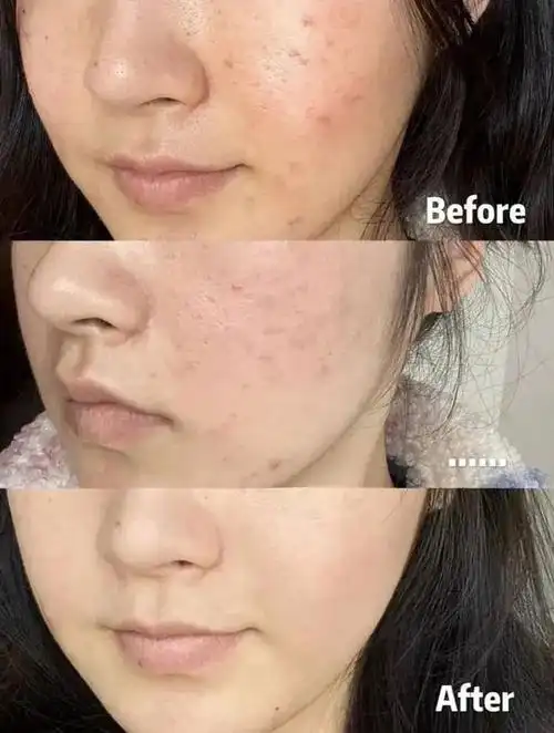 不用涂不用抹每天用它洗洗澡皮肤再也不瘙痒