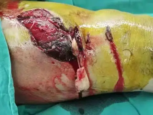 内蒙古民族大学附属医院创伤中心成功抢救一名高空坠落造成多发复合伤