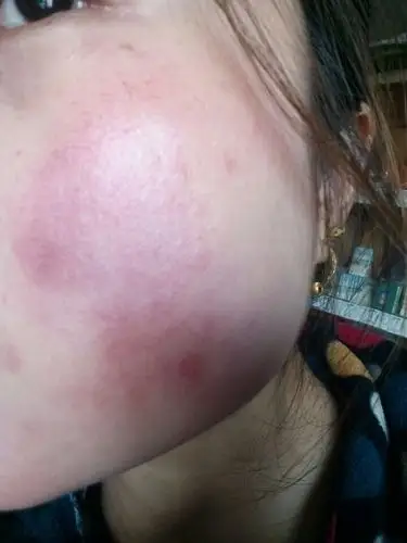 当脸遇上红血丝!我该怎么办?