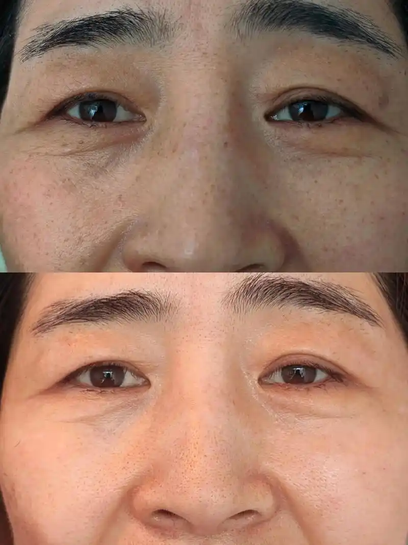 卤菜店的小姐姐在我家做的祛黄,美白淡斑项目,前后对比图. - 抖音