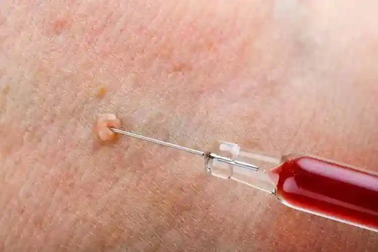 大腿根部长了不疼不痒的"肉球",是尖锐湿疣吗?怎么处理?