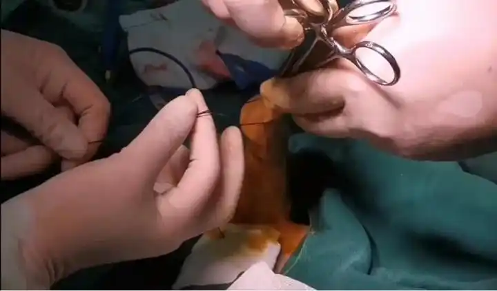 手术演示吻合器包皮环切术优点①手术时间短,安全无痛苦:手术时间仅需