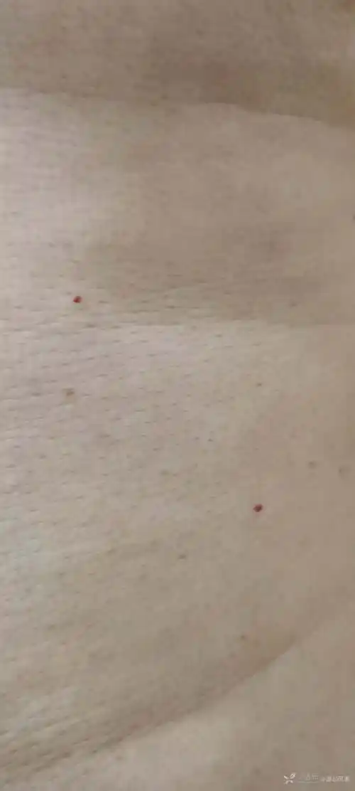 胸背部小红点疑似毛细血管病变还是激素问题