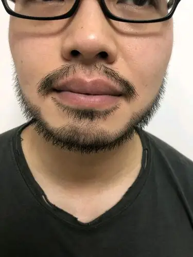 男士胡须鬓角种植案例#有人看得出来这是种植的胡须鬓角吗?