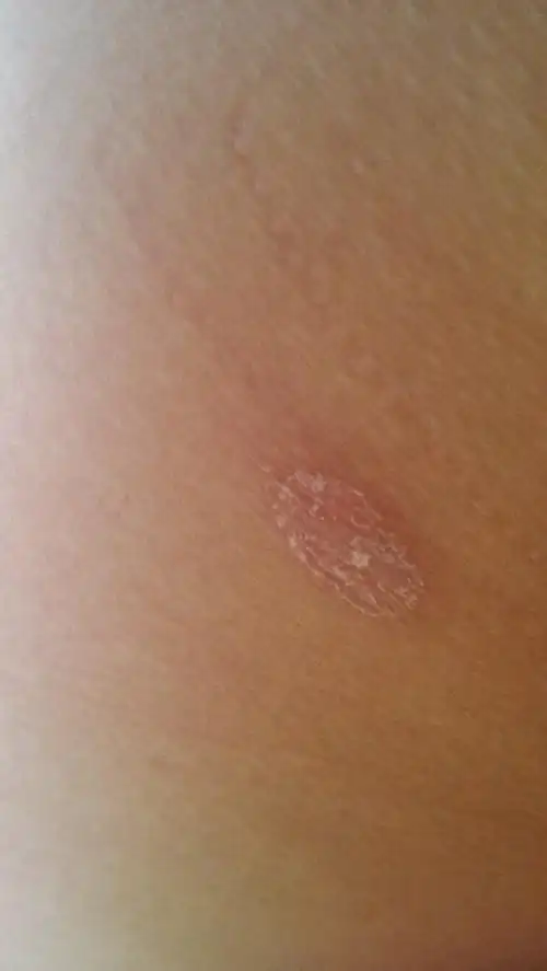 有白色粗糙的癣屁股上刚刚发现底下红不痛不痒