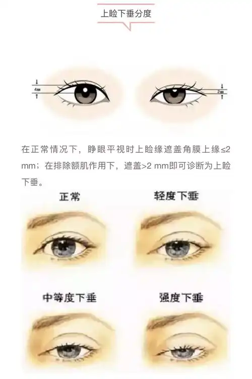 为什么眼睛总是无神睁不开有一种情况叫提肌无力