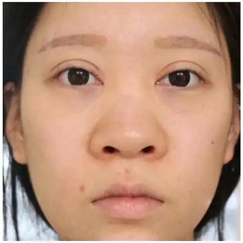 天生没有鼻梁星人可能说的就是我,整体看上去我的脸中_圈子-新氧美容