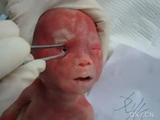 【共享】典型胎儿引产后图片