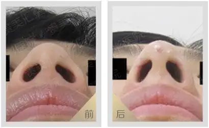 鼻翼缩小成功案例