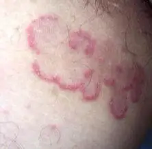 小偏方治疗男性阴囊瘙痒 轻松排解您的烦恼