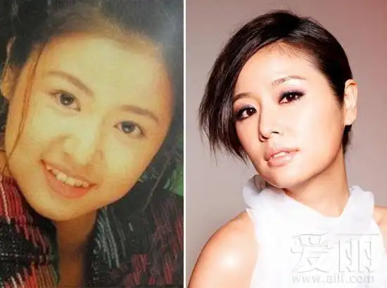 林心如整牙前后对比