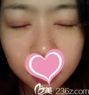 双眼皮手术后14天闭眼照