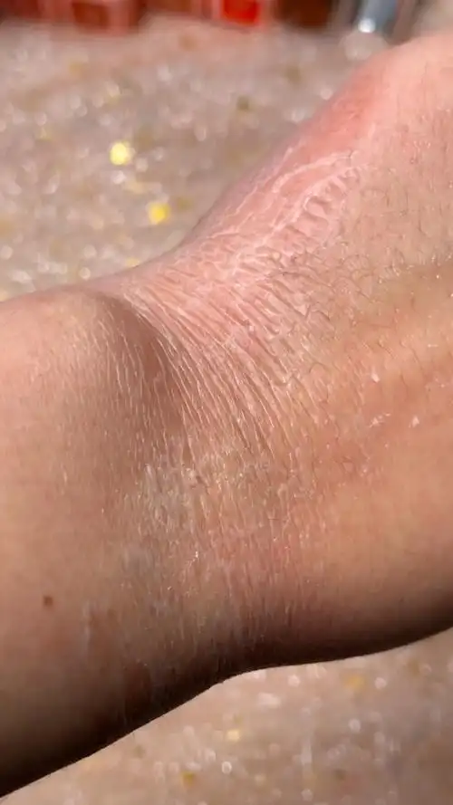 秋冬季节皮肤干燥脱皮怎么办