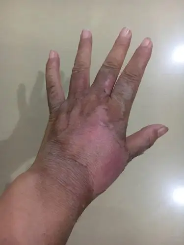 左手烫伤,治疗记