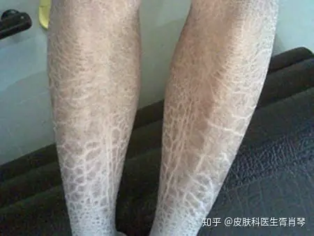 皮肤病常见类型腿上长的像鳞片一样东西是什么
