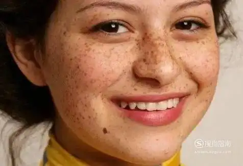 脸上长雀斑如何去除 - vvvtt互动问答平台