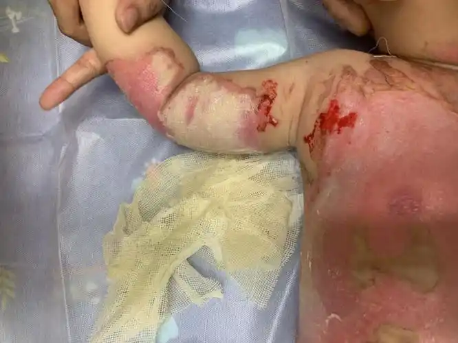 福州2岁男宝宝被开水烫伤……第一时间该怎么做?-福建省福州儿童医院