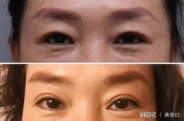 大连爱德丽格刘志刚院长做双眼皮会有年龄限制吗