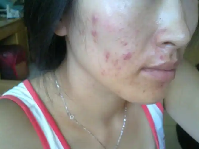 痘痘肌肤怎么改善