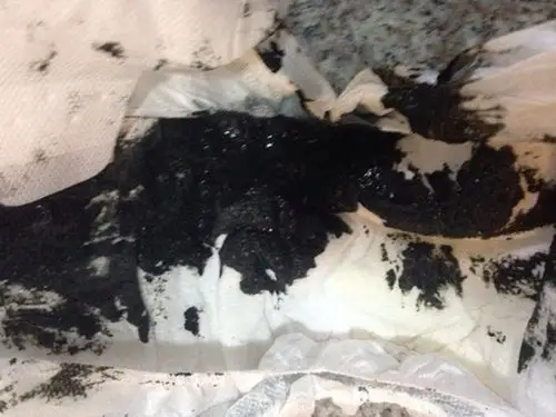 胃癌黑大便图片 (38)