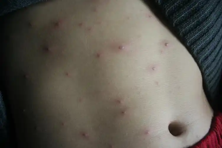 病毒性皮肤病春季皮肤病病例征集