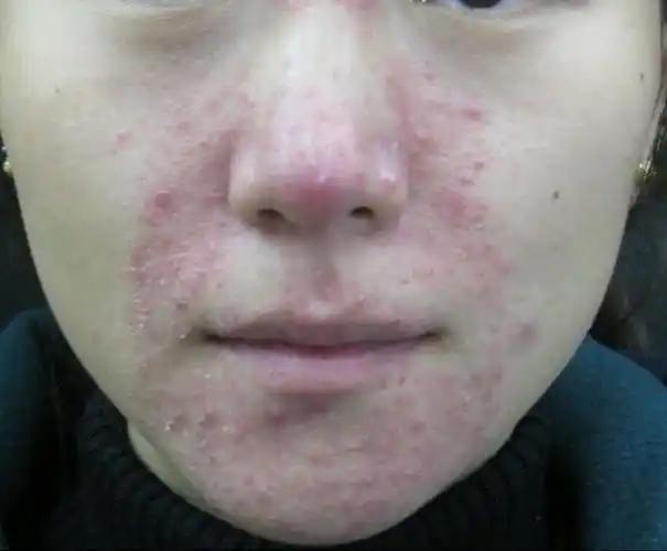 脸部严重泛红长疹可能是这4种皮肤病
