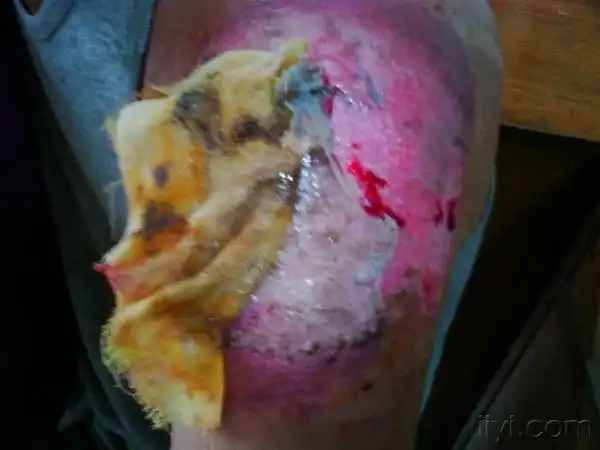 伤口结痂的处理