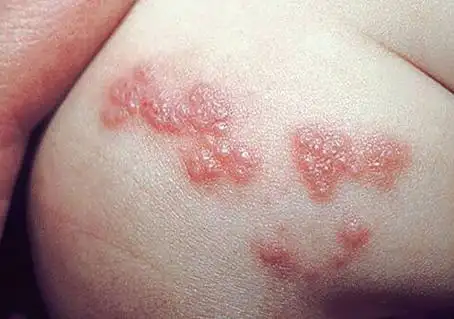 皮肤的反应和健康状况取决于人体的个体特征及其对各种过敏原作用的