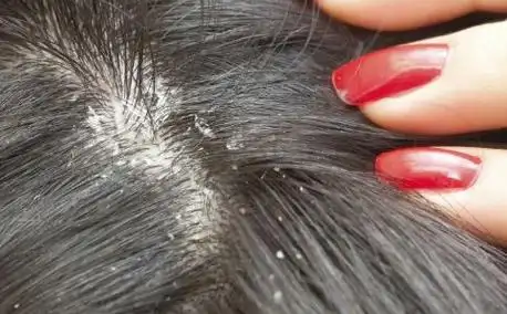 头皮屑大块怎么破只需1招让你头屑去无踪