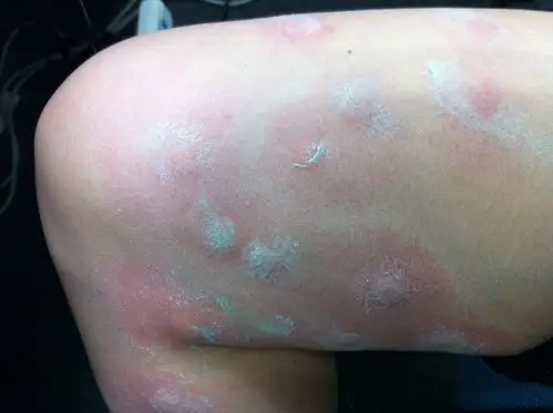 我一早起来,一条腿上起了好多的疙瘩,刚开始是红色点点,后来变大变硬