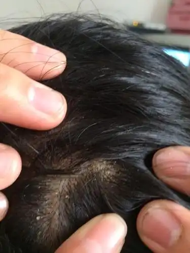 头发流水,然后结好多黄色的疤,这是昨晚才洗的头