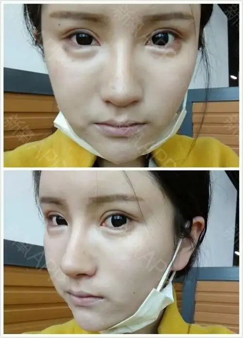 肇庆华美整形,下眼睑下至术 开外眼角术后146天# 【题外话】大家好