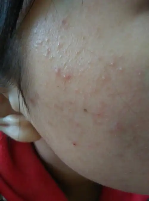 不知道是痘痘还是什么皮肤病,求懂的帮我哭的!