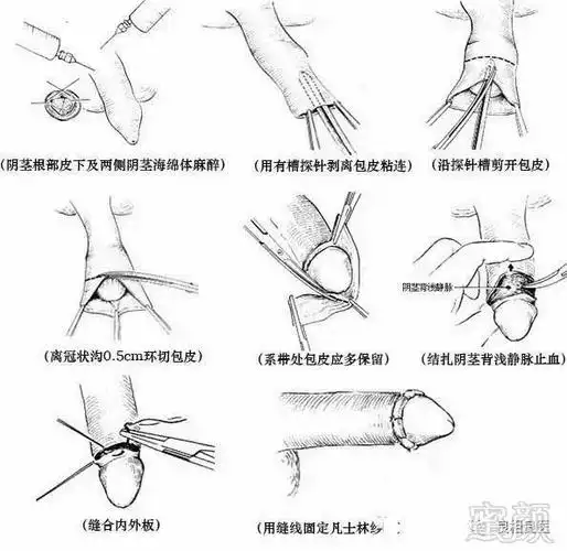 4)传统手术技术方法⑥杜绝包皮龟头炎症和包皮垢对性伴侣不良影响