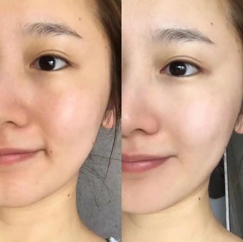 美白产品能淡化色斑?超皮秒淡斑嫩肤一步到位?