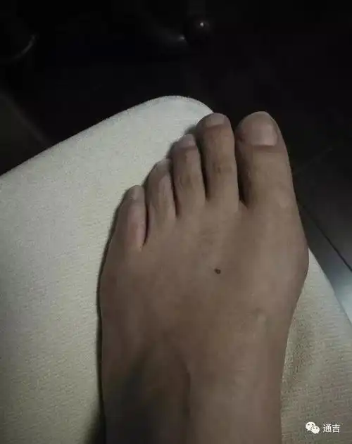 脚上相术图解脚上长痣