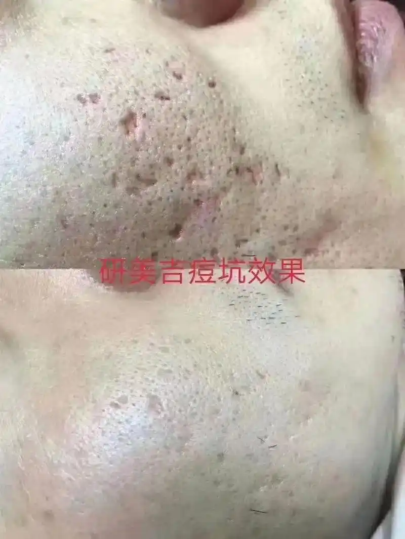 痘坑修复案例#同城好店推荐 #解决任何皮肤问题 #好产品一起 - 抖音