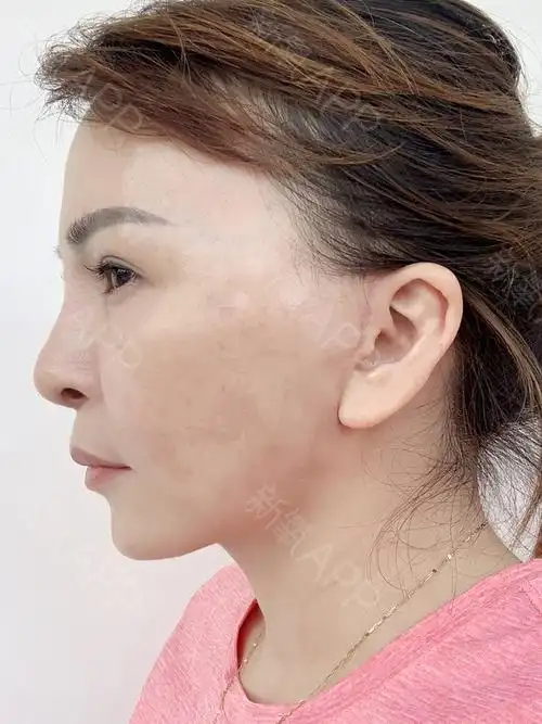 深圳希思医疗美容医院微创小切口拉皮