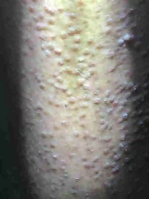 这是什么皮肤病