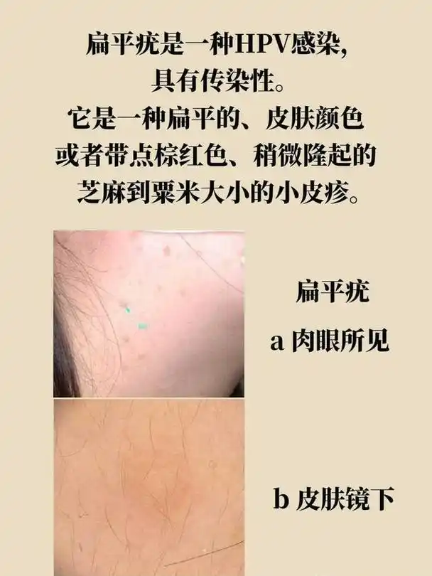 导语:脖子上有小肉疙瘩的原因主要考虑为皮赘和疣.