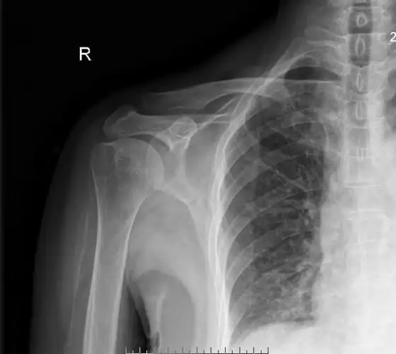中西医结合治疗右肩胛骨粉碎骨折气滞血瘀