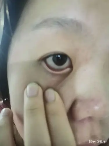 在玩手机,眼睛有点痒就揉了一下,就觉得下眼皮角膜