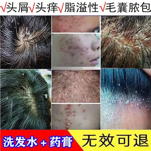 去头毛囊炎背部神器囊炎治疗头癣脓包头皮洗发水内容分答