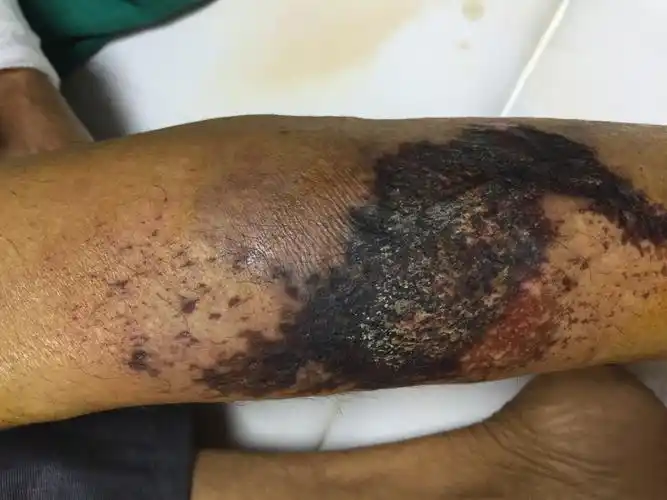 请问这种是皮肤坏死了吗