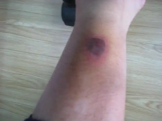 被暖宝烫伤了小腿,形成了一个绿豆大的小水泡,能不能刺破水泡包扎伤口