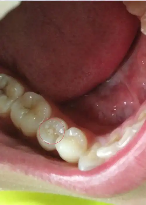 第三前磨牙中间长出了很小的牙