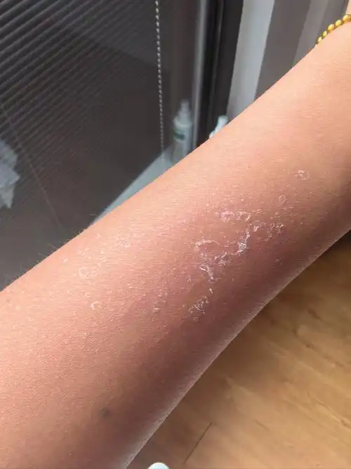 正真的剥层皮[懵逼]